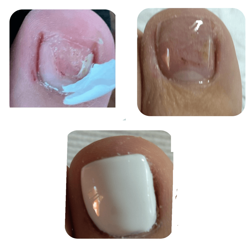 Reconstrucción en Gel Medicado